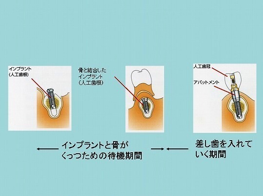 まみクリ新聞 〜インプラント特集〜